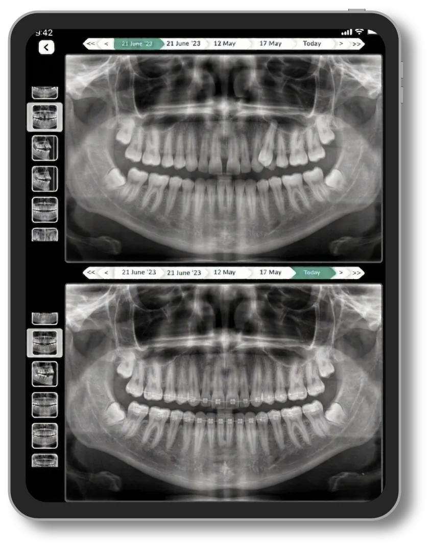 Lifemaan image comparison: dental panoramic X-rays from two visits shown one above the other