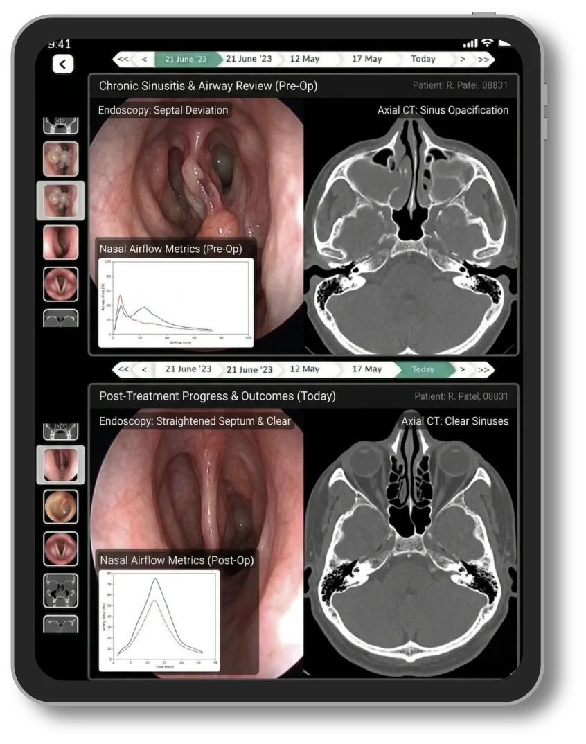 Lifemaan image comparison: nasal endoscopy and sinus CT images before and after surgery shown one above the other