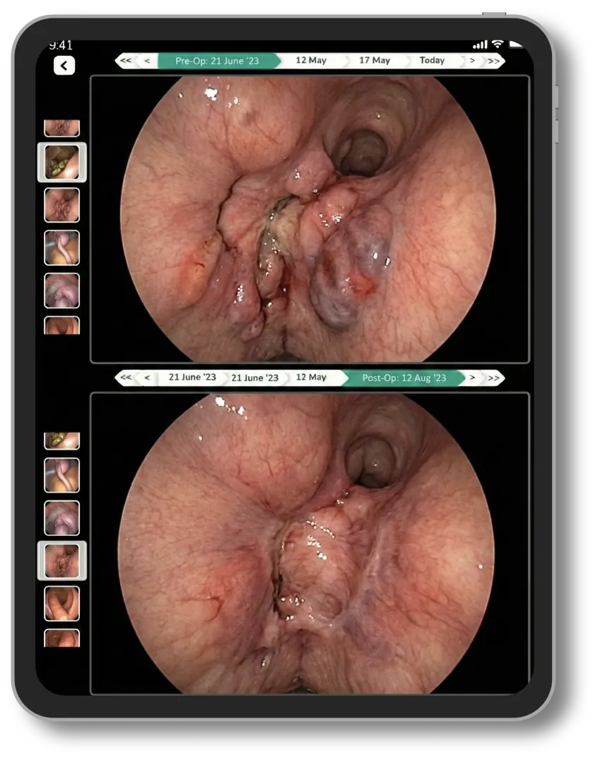 Lifemaan image comparison: endoscopy images before and after surgery shown one above the other